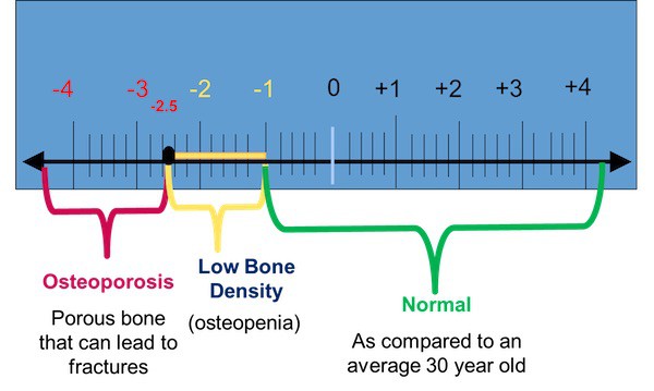 osteoporosis+DEXA-Tscores
