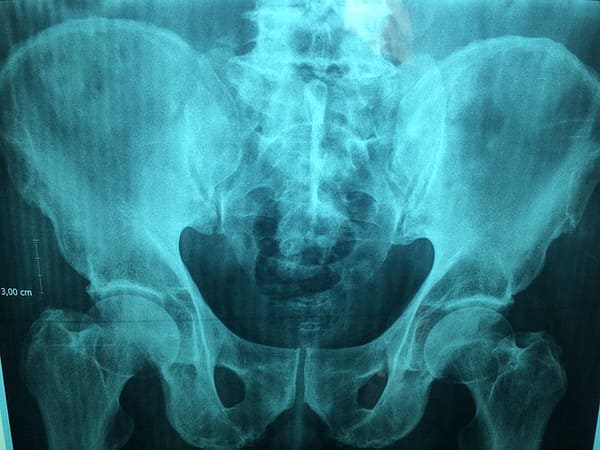 osteoporosis+pelvis-x-ray
