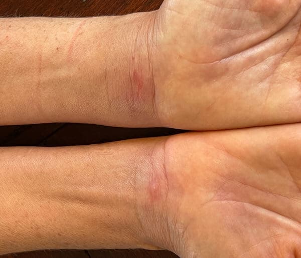 experience-with-CTS_incision-scars