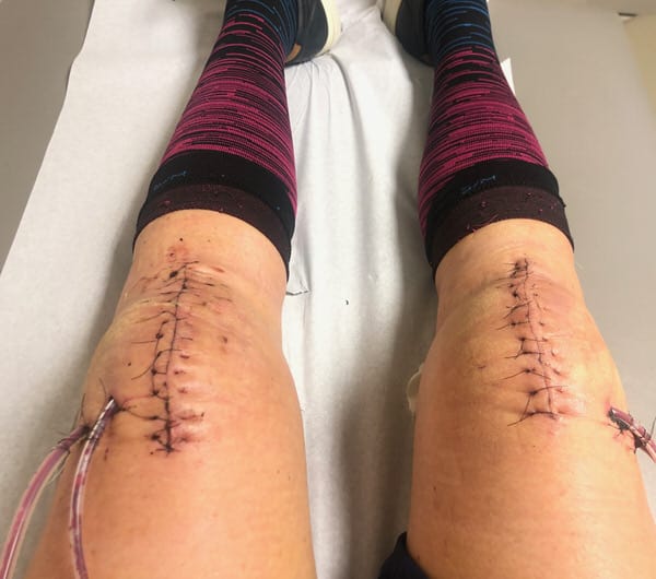kneecap replacement
